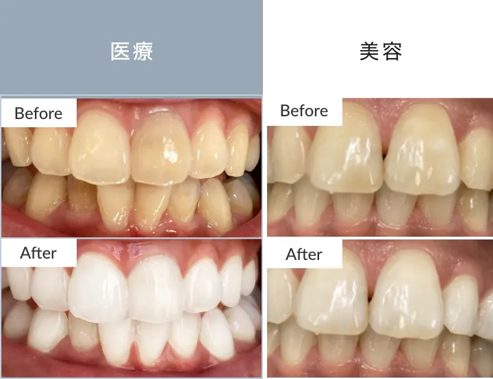 美容と医療ホワイトニングの効果の違い